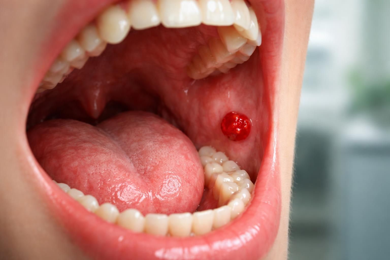 Petite boule de sang dans la bouche : quand consulter un médecin ?