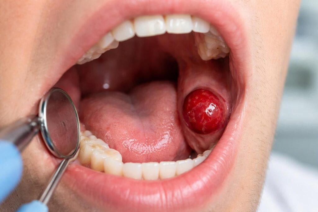 Les maladies pouvant provoquer une boule de sang dans la bouche